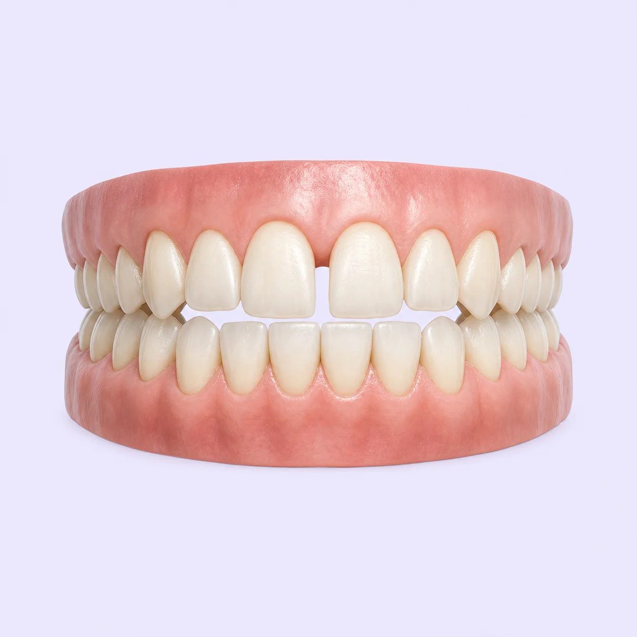 Dental model illustrating a gap between the upper front teeth